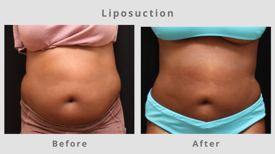 Liposuction Before & After Pictures