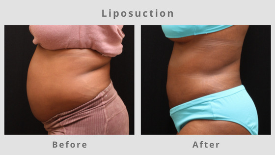 Liposuction Before & After Pictures