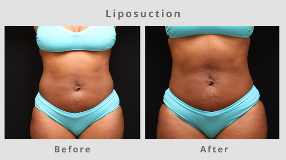 Liposuction Before & After Pictures