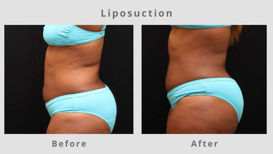 Liposuction Before & After Pictures