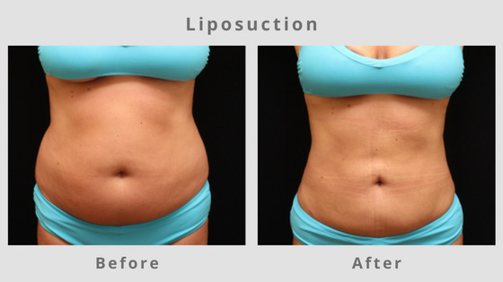 Liposuction Before & After Pictures