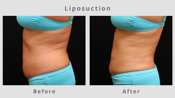 Liposuction Before & After Pictures