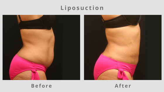 Liposuction Before & After Pictures