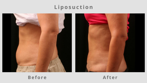 Liposuction Before & After Pictures