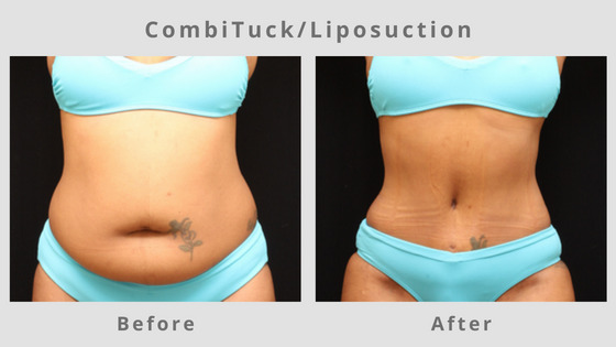 Liposuction Before & After Pictures