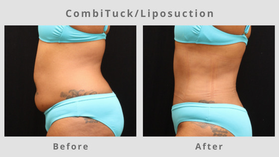 Liposuction Before & After Pictures